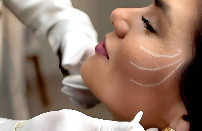 Aplicación de Bioestimuladores SCULPTRA, RADIESSE