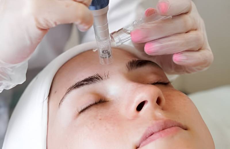 Microneedling con PDRN de salmón