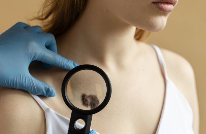 Procedimientos quirúrgicos de mínima invasión, aplicación de crioterapia, retiro de lunares y verrugas.