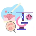 Toma de biopsias en dermatologia en queretaro